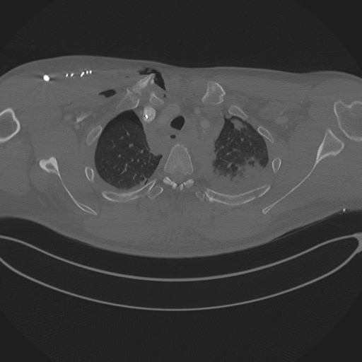 Chest multitrauma - aortic injury (Radiopaedia 34708-36147 Axial bone window 57).png