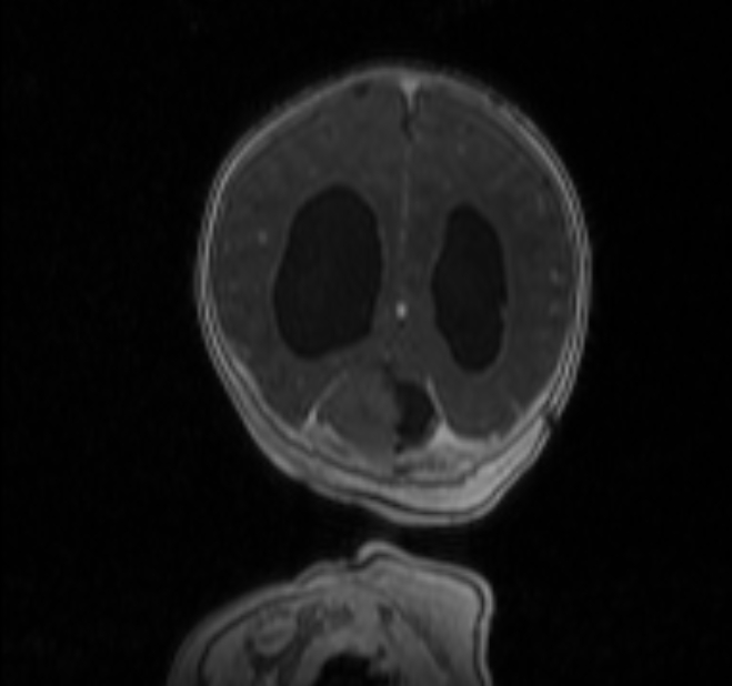 Chiari III malformation with occipital encephalocele (Radiopaedia 79446-92559 Coronal T1 C+ mpr 34).jpg