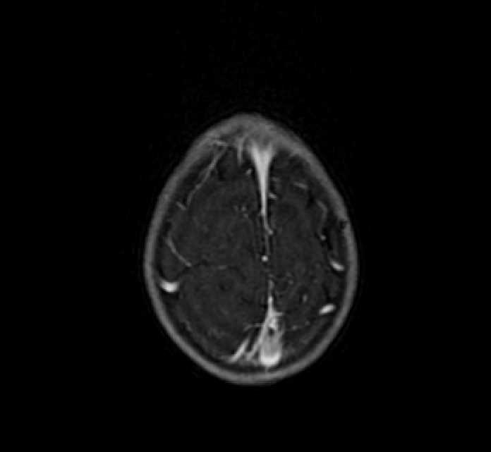 Chiasmatic-hypothalamic glioma (Radiopaedia 90079-107252 Axial T1 C+ 83).jpg