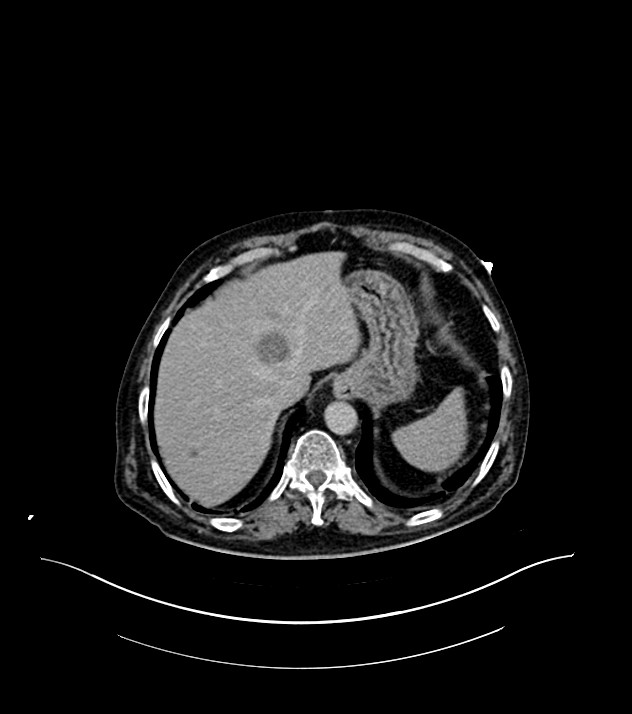Cholangiocarcinoma with cerebral metastases (Radiopaedia 83519-98629 Axial C+ delayed 16).jpg