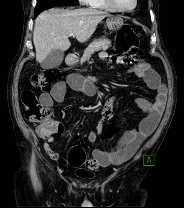 Cholangiocarcinoma with cerebral metastases (Radiopaedia 83519-98629 G 29).jpg
