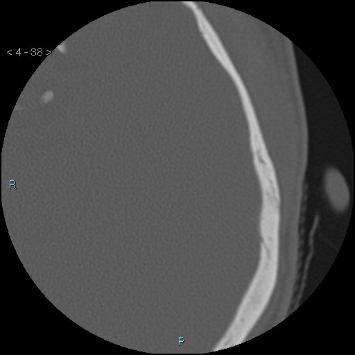 File:Cholesterol granuloma of the petrous apex (Radiopaedia 64358-73141 Axial bone window 19).jpg