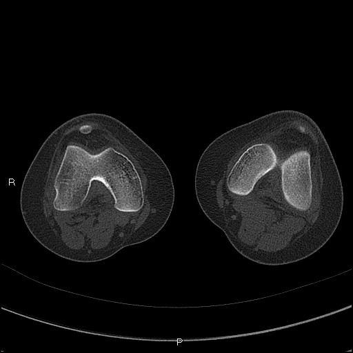 Chondroblastoma (Radiopaedia 62721-71030 Axial bone window 23).jpg