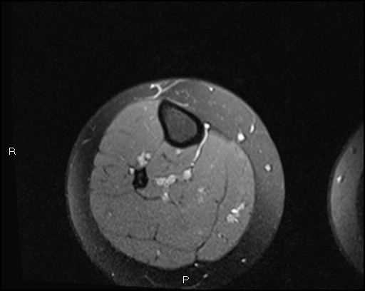 File:Chondroblastoma (Radiopaedia 62721-71031 Axial PD fat sat 41).jpg