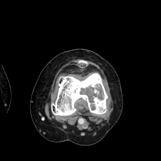 Chondrosarcoma - femur (Radiopaedia 64187-72954 Axial with contrast 50).jpg