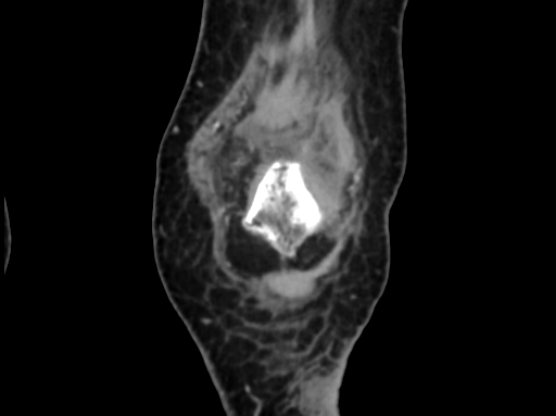Chondrosarcoma - femur (Radiopaedia 64187-72954 C 10).jpg