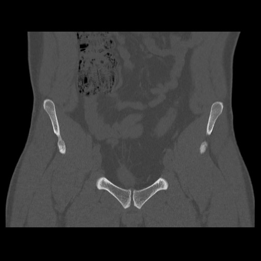 Chondrosarcoma of iliac wing (Radiopaedia 63861-72599 Coronal bone window 37).jpg