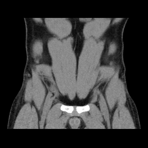 Chondrosarcoma of iliac wing (Radiopaedia 63861-72599 Coronal non-contrast 28).jpg