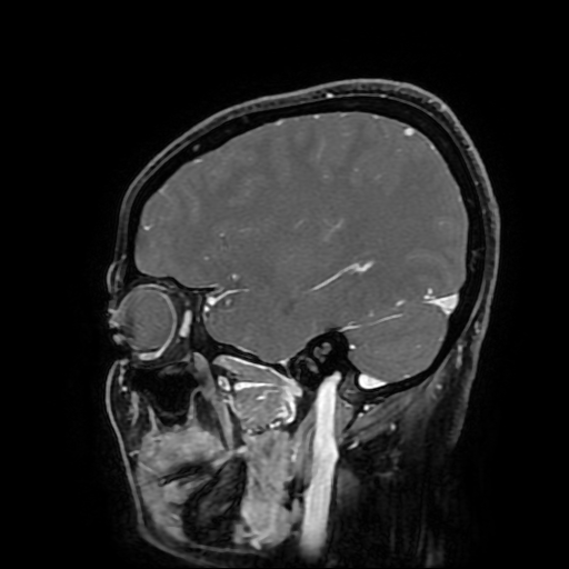 Chordoid glioma of third ventricle (Radiopaedia 91612-109340 F 64).jpg
