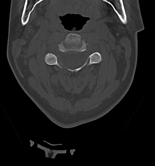 Chordoma (C4 vertebra) (Radiopaedia 47561-52188 Axial bone window 17).png