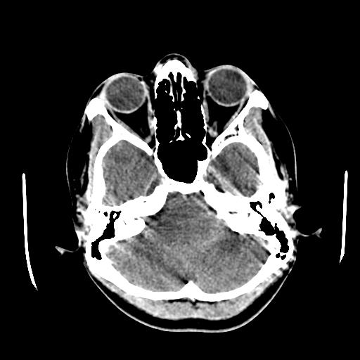 File:Choriocarcinoma of ovary with cerebral and pulmonary metastases (Radiopaedia 25983-26118 C+ arterial phase 29).jpg