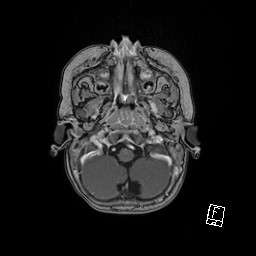 Choroid plexus papilloma (Radiopaedia 92022-109829 Axial T1 C+ 7).jpg