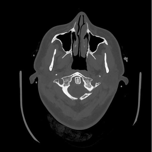 Choroid plexus papilloma extending into the cerebellopontine angle cistern (Radiopaedia 85941-101833 Axial bone window 11).png
