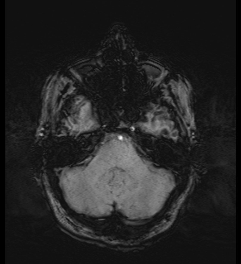 Choroid plexus xanthogranuloma (Radiopaedia 91271-108875 Axial SWI 16).jpg