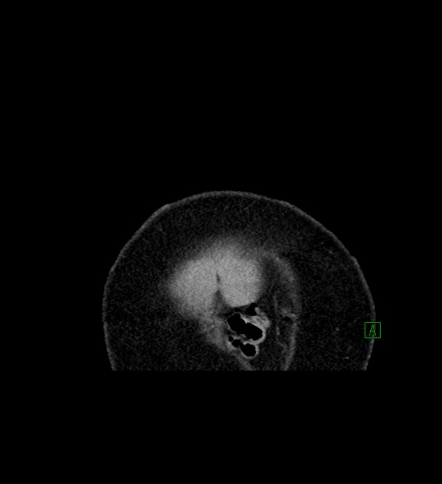 Chromophobe renal cell carcinoma (Radiopaedia 84239-99519 C 2).jpg