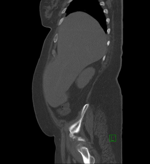Chromophobe renal cell carcinoma (Radiopaedia 84239-99519 Sagittal bone window 88).jpg