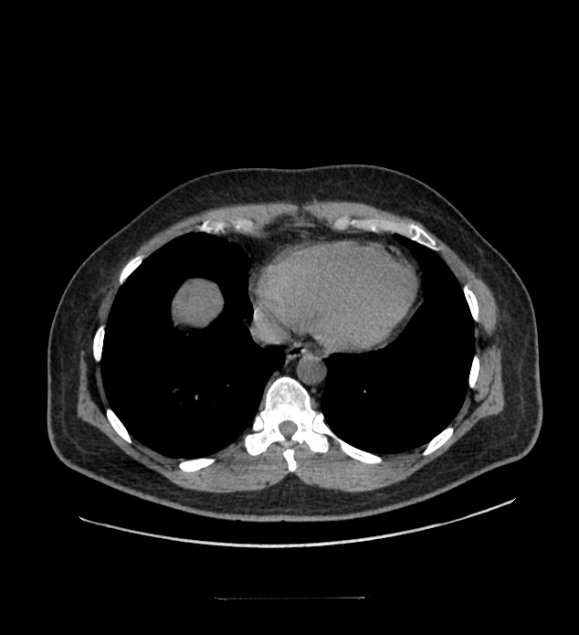 Chromophobe renal cell carcinoma (Radiopaedia 84337-99644 Axial non-contrast 2).jpg