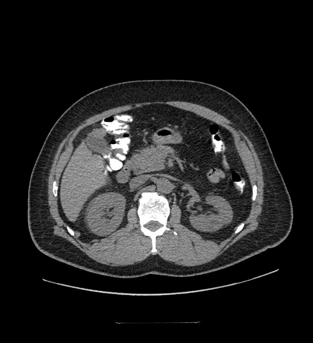Chromophobe renal cell carcinoma (Radiopaedia 84337-99644 Axial non-contrast 36).jpg