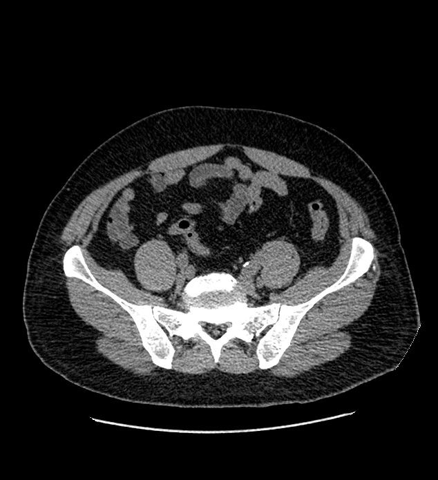 Chromophobe renal cell carcinoma (Radiopaedia 84337-99693 Axial non-contrast 116).jpg