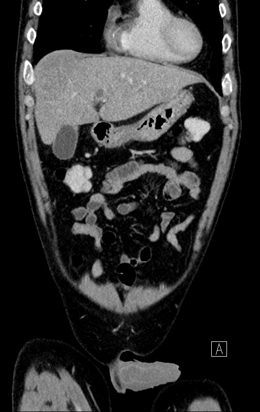 Chronic appendicitis complicated by appendicular abscess, pylephlebitis and liver abscess (Radiopaedia 54483-60700 C 20).jpg