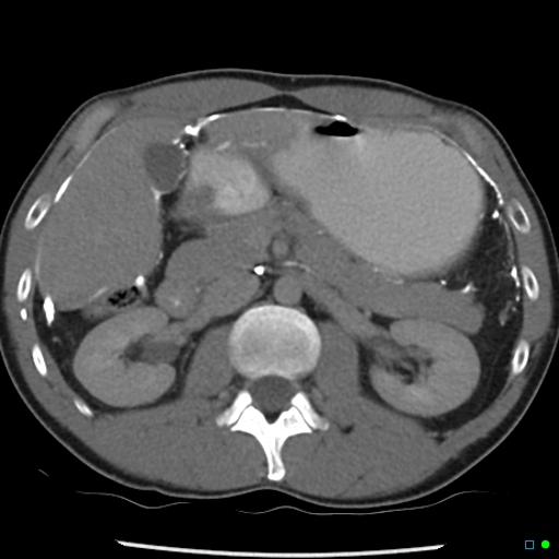 File:Chronic barium peritonitis and small bowel obstruction (Radiopaedia 29151-29548 D 4).jpg