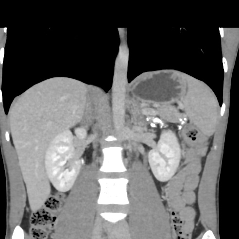 File:Chronic calcific pancreatitis (Radiopaedia 56280-62953 F 16).jpg