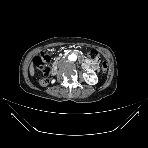File:Chronic contained rupture of abdominal aortic aneurysm with extensive erosion of the vertebral bodies (Radiopaedia 55450-61901 A 25).jpg