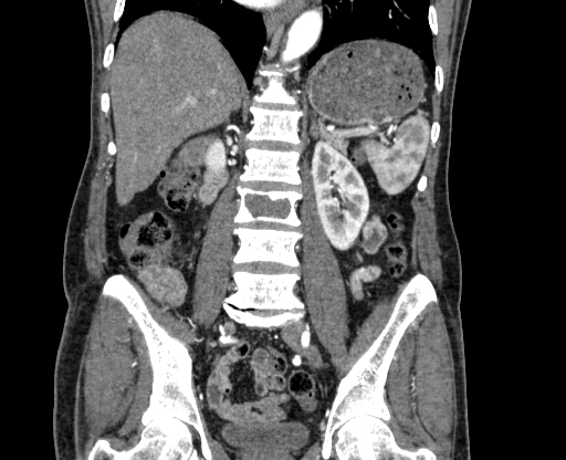 Chronic contained rupture of abdominal aortic aneurysm with extensive erosion of the vertebral bodies (Radiopaedia 55450-61901 D 48).jpg