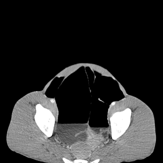 File:Chronic large bowel pseudo-obstruction (Radiopaedia 43181-46492 A 146).jpg