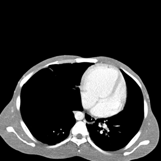 Chronic large bowel pseudo-obstruction (Radiopaedia 43181-46492 A 21).jpg