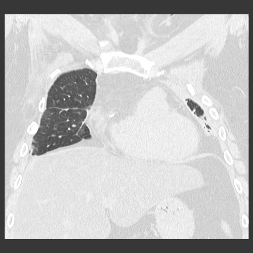 Chronic lung allograft dysfunction - restrictive form (Radiopaedia 60595-68316 Coronal lung window 38).jpg