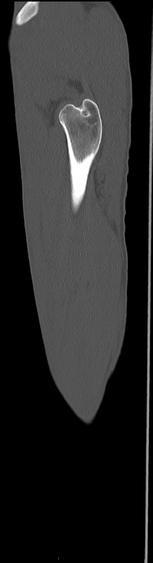 Chronic osteomyelitis (with sequestrum) (Radiopaedia 74813-85822 C 17).jpg