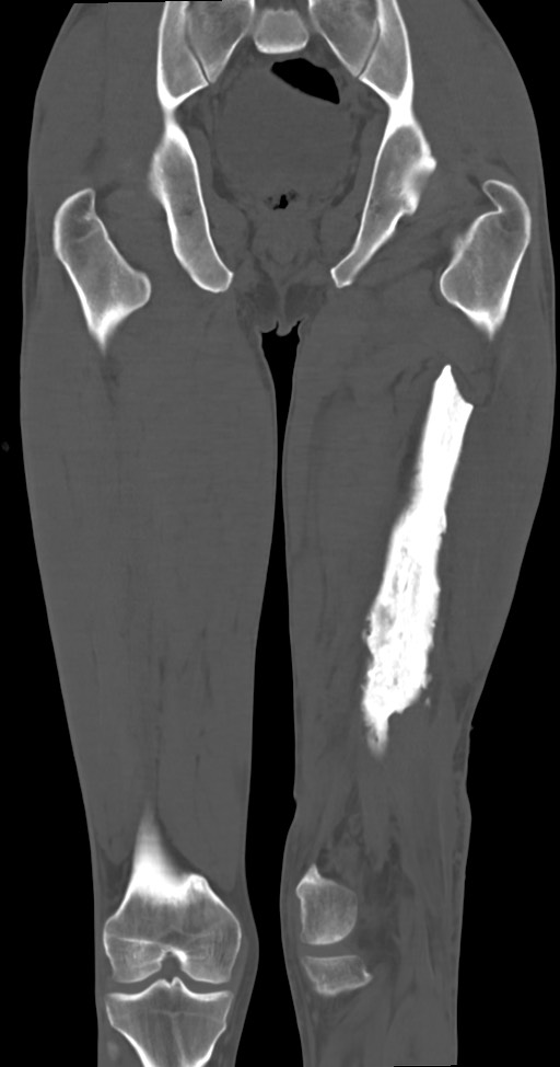 Chronic osteomyelitis (with sequestrum) (Radiopaedia 74813-85822 Coronal non-contrast 35).jpg
