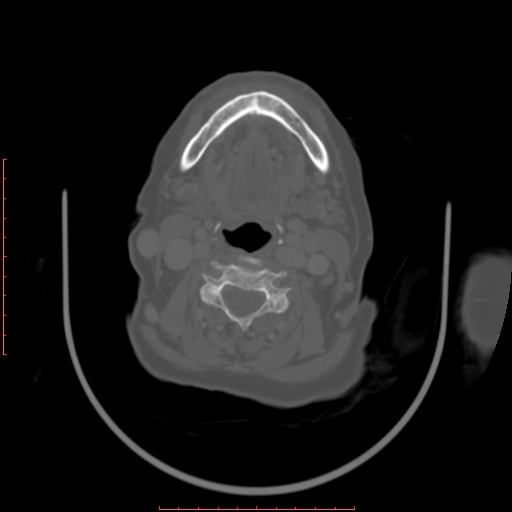 Chronic osteomyelitis - maxilla (Radiopaedia 23783-23927 Axial bone window 20).jpg