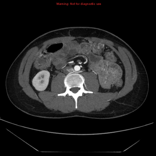 File:Circumaortic left renal vein (Radiopaedia 9069-9792 A 36).jpg