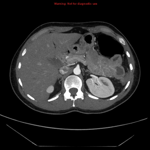 File:Circumaortic left renal vein (Radiopaedia 9069-9792 A 9).jpg