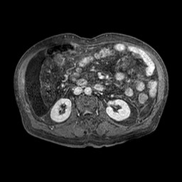 File:Cirrhosis and hepatocellular carcinoma in the setting of hemochromatosis (Radiopaedia 75394-86594 Axial T1 C+ fat sat 275).jpg