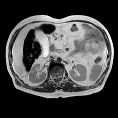 File:Cirrhosis and hepatocellular carcinoma in the setting of hemochromatosis (Radiopaedia 75394-86594 Axial T2 10).jpg