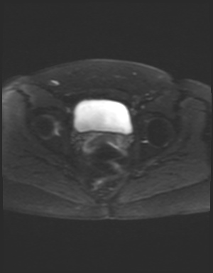 Class II Mullerian duct anomaly- unicornuate uterus with rudimentary horn and non-communicating cavity (Radiopaedia 39441-41755 Axial DWI 20).jpg