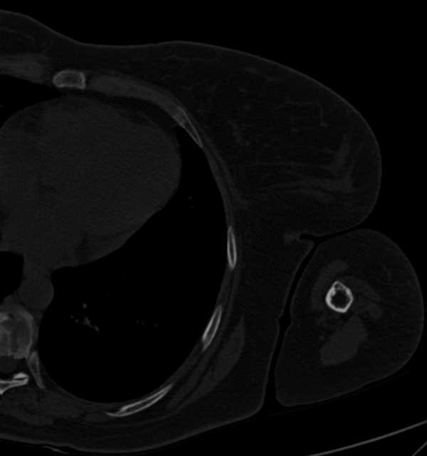 Clear cell chondrosarcoma - humerus (Radiopaedia 63104-71612 Axial bone window 109).jpg