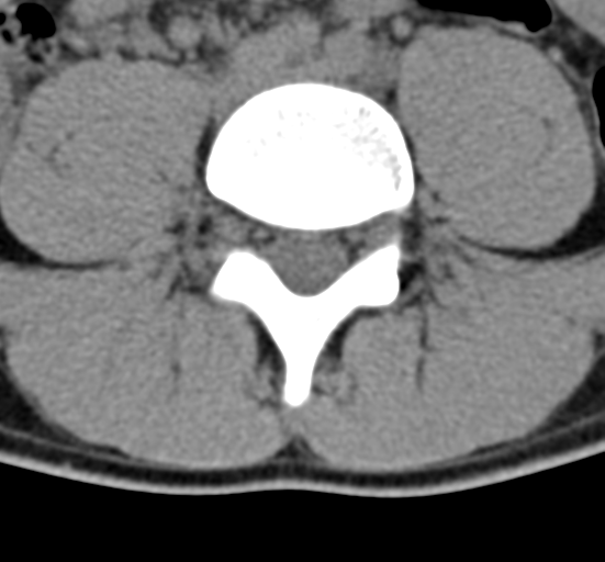 Clear cell meningoma - lumbar spine (Radiopaedia 60116-67691 Axial non-contrast 52).png