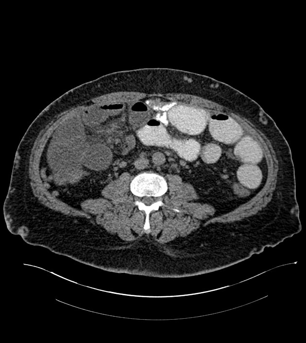 Closed-loop small bowel obstruction-internal hernia (Radiopaedia 78439-91096 Axial non-contrast 87).jpg