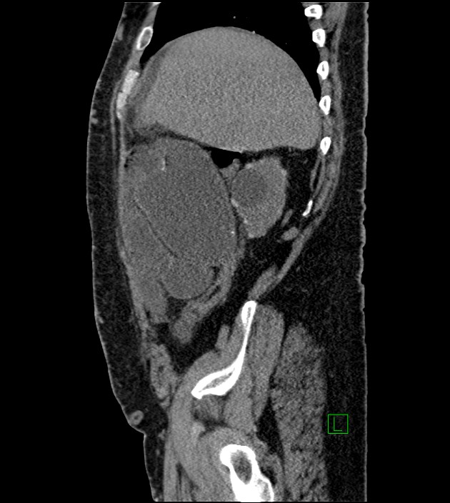 Closed-loop small bowel obstruction-internal hernia (Radiopaedia 78439-91096 C 112).jpg
