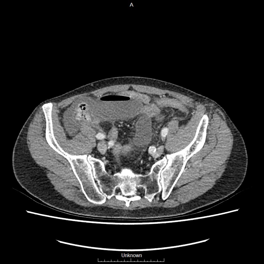 Closed loop bowel obstruction and ischemia (Radiopaedia 86959-103180 A 68).jpg