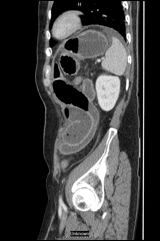 Closed loop bowel obstruction and ischemia (Radiopaedia 86959-103180 C 11).jpg