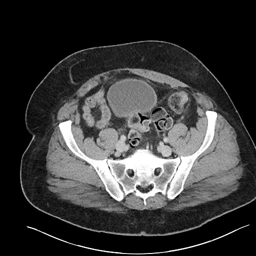 File:Closed loop obstruction - internal hernia into nephrectomy bed (Radiopaedia 59867-67320 A 110).jpg
