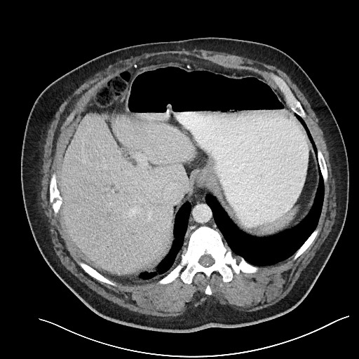 File:Closed loop obstruction - internal hernia into nephrectomy bed (Radiopaedia 59867-67320 A 28).jpg