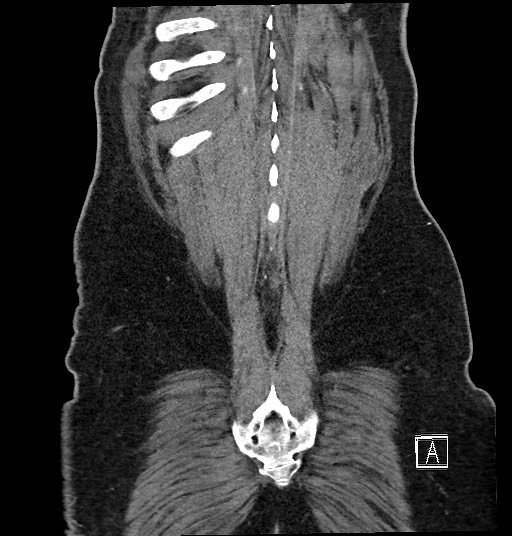 File:Closed loop obstruction - internal hernia into nephrectomy bed (Radiopaedia 59867-67320 B 133).jpg