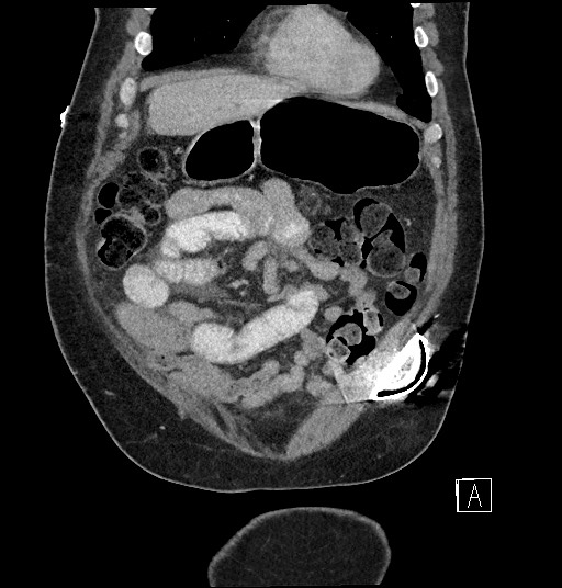 Closed loop obstruction - internal hernia into nephrectomy bed (Radiopaedia 59867-67320 B 25).jpg