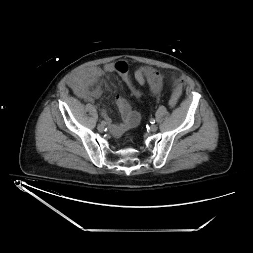 Closed loop obstruction due to adhesive band, resulting in small bowel ischemia and resection (Radiopaedia 83835-99023 Axial non-contrast 120).jpg